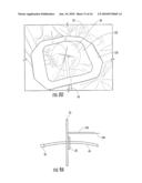 SURGICAL DRAPES WITH PATCHES TO PROVIDE PORTS diagram and image