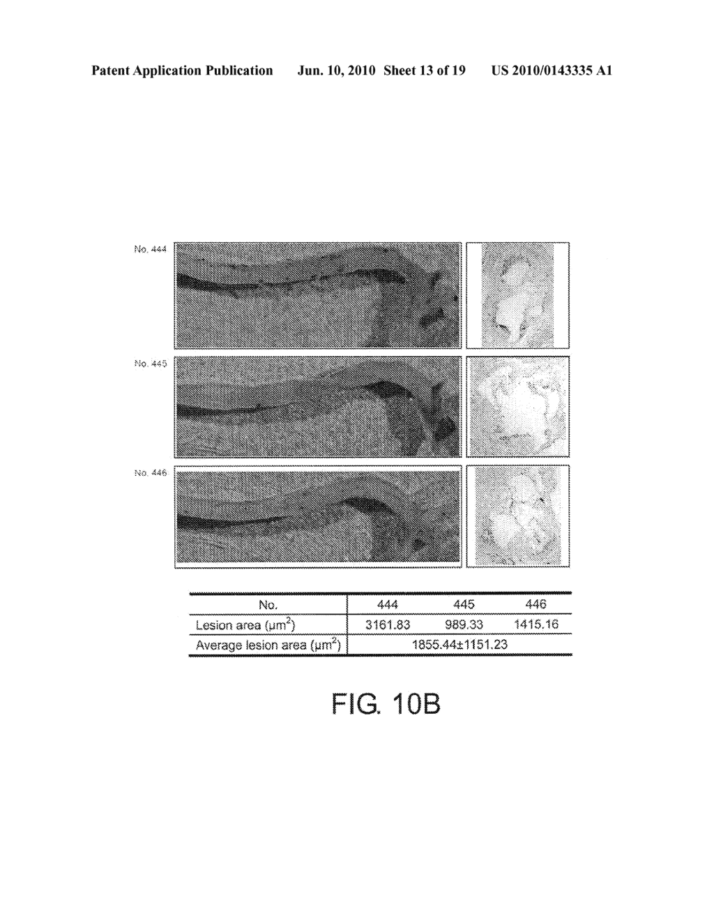 TREATING ATHEROSCLEROSIS - diagram, schematic, and image 14