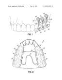 ORTHODONTIC ANTERIOR OPEN-BITE SPLINT diagram and image