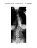 CHD7 GENE POLYMORPHISMS ARE ASSOCIATED WITH SUSCEPTIBILITY TO IDIOPATHIC SCOLIOSIS diagram and image