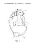 IMPLANTABLE HEART ASSIST SYSTEM AND METHOD OF APPLYING SAME diagram and image