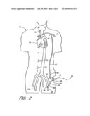 IMPLANTABLE HEART ASSIST SYSTEM AND METHOD OF APPLYING SAME diagram and image