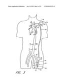 IMPLANTABLE HEART ASSIST SYSTEM AND METHOD OF APPLYING SAME diagram and image