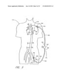 IMPLANTABLE HEART ASSIST SYSTEM AND METHOD OF APPLYING SAME diagram and image