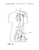 IMPLANTABLE HEART ASSIST SYSTEM AND METHOD OF APPLYING SAME diagram and image