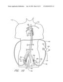 IMPLANTABLE HEART ASSIST SYSTEM AND METHOD OF APPLYING SAME diagram and image