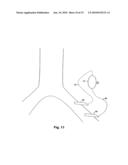 IMPLANTABLE HEART ASSIST SYSTEM AND METHOD OF APPLYING SAME diagram and image