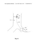 IMPLANTABLE HEART ASSIST SYSTEM AND METHOD OF APPLYING SAME diagram and image