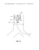 IMPLANTABLE HEART ASSIST SYSTEM AND METHOD OF APPLYING SAME diagram and image