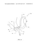 IMPLANTABLE HEART ASSIST SYSTEM AND METHOD OF APPLYING SAME diagram and image