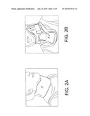 MAGNETIC DEVICE FOR GUIDING CATHETER AND METHOD OF USE THEREFOR diagram and image