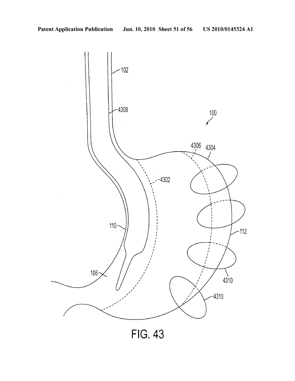 GASTRIC RESTRICTION DEVICES WITH FILLABLE CHAMBERS AND ABLATION MEANS FOR TREATING OBESITY - diagram, schematic, and image 52