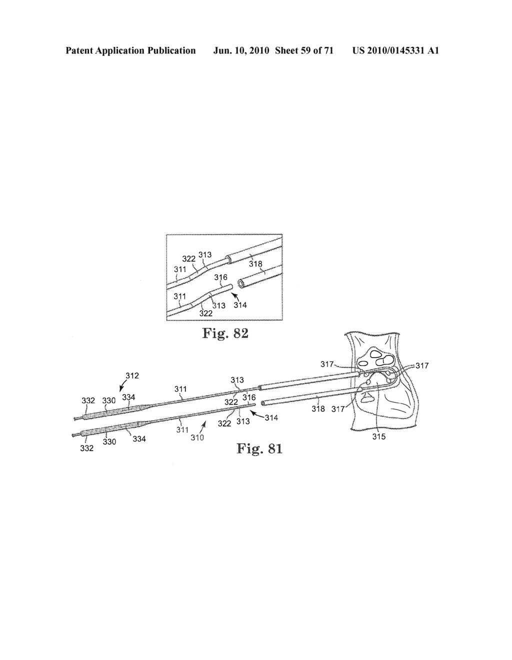 Loop Ablation Apparatus and Method - diagram, schematic, and image 60