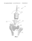 METHOD AND SYSTEM FOR COMPUTER ASSISTED SURGERY FOR BICOMPARTMENTAL KNEE REPLACEMENT diagram and image