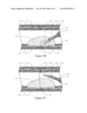 HOOD METHOD AND DEVICE FOR ENDOSCOPIC SUBMUCOSAL DISSECTION diagram and image