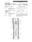 Irrigating Catch and Removal Device diagram and image