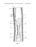 Irrigating Catch and Removal Device diagram and image