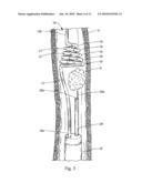 Irrigating Catch and Removal Device diagram and image