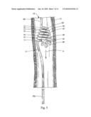 Irrigating Catch and Removal Device diagram and image