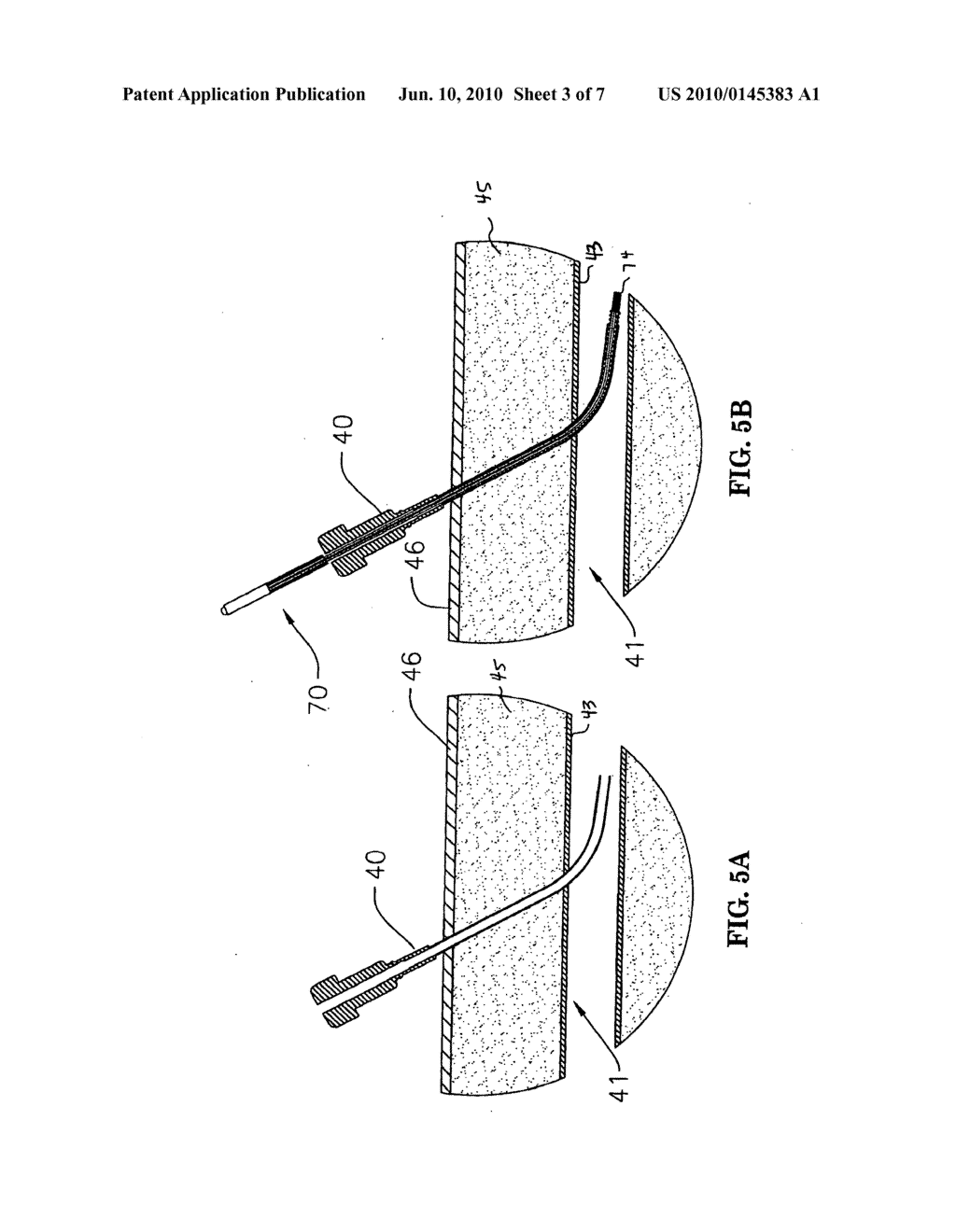 DRUG ELUTING VASCULAR CLOSURE DEVICES AND METHODS - diagram, schematic, and image 04