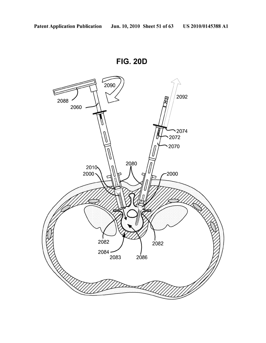 LOW PROFILE SPINAL PROSTHESIS INCORPORATING A BONE ANCHOR HAVING A DEFLECTABLE POST AND A COMPOUND SPINAL ROD - diagram, schematic, and image 52