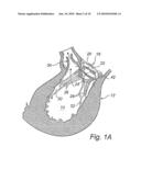 Device And Method For Improving Function Of Heart Valve diagram and image