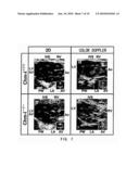 THERAPEUTIC AGENTS FOR ANGIOGENESIS-RELATED DISEASES COMPRISING CHONDROMODULIN-I AS ACTIVE INGREDIENT diagram and image