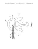 INTERVERTEBRAL DISC NUCLEUS REPLACEMENT PROSTHESIS diagram and image