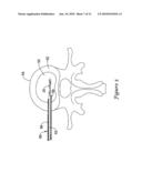 INTERVERTEBRAL DISC NUCLEUS REPLACEMENT PROSTHESIS diagram and image