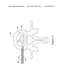 INTERVERTEBRAL DISC NUCLEUS REPLACEMENT PROSTHESIS diagram and image