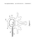 INTERVERTEBRAL DISC NUCLEUS REPLACEMENT PROSTHESIS diagram and image