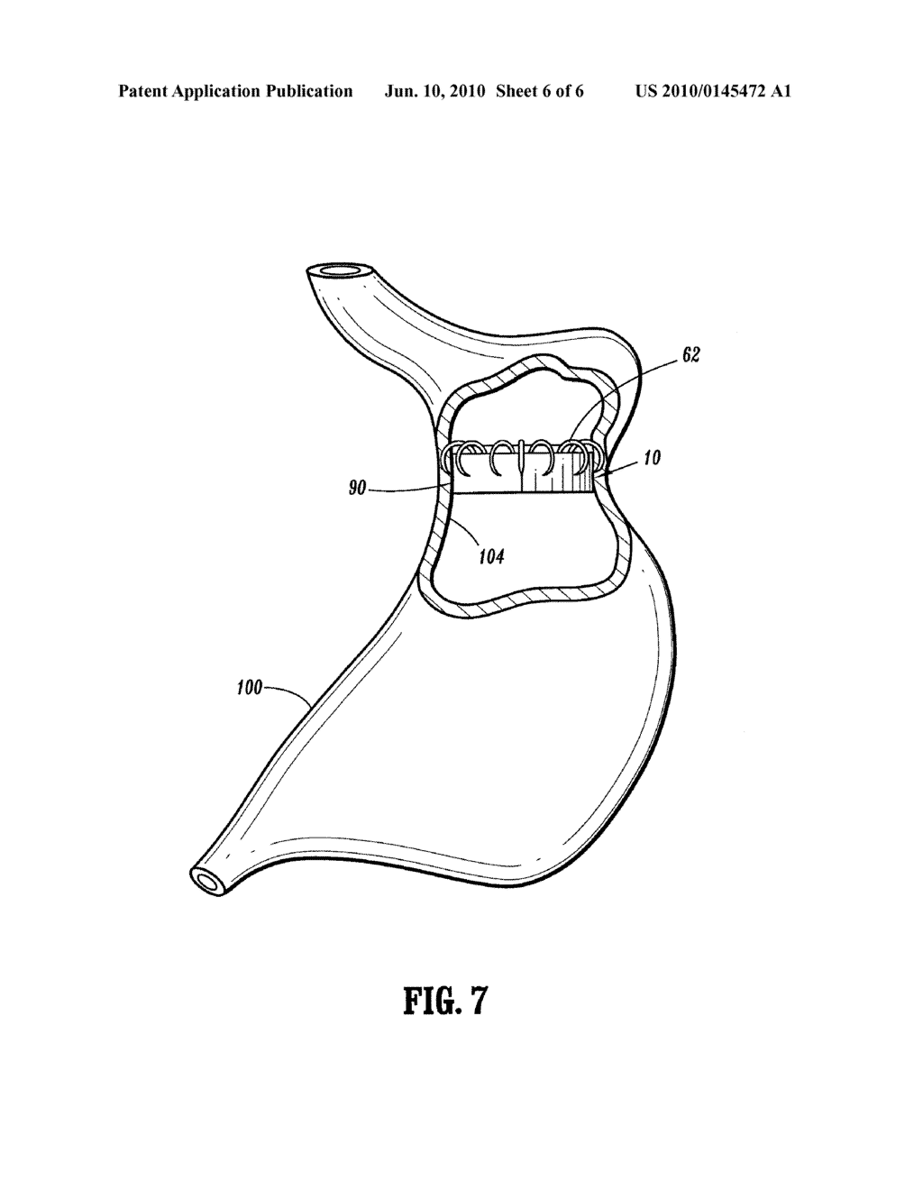 Gastric Restrictor Assembly And Method Of Use - diagram, schematic, and image 07