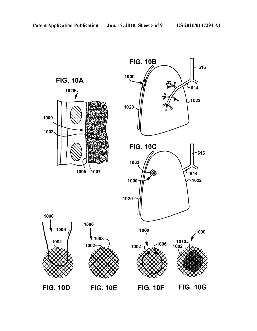 DEVICES AND METHODS TO MAINTAIN THE PATENCY OF AN OPENING RELATIVE TO PARENCHYMAL TISSUE OF THE LUNG - diagram, schematic, and image 06