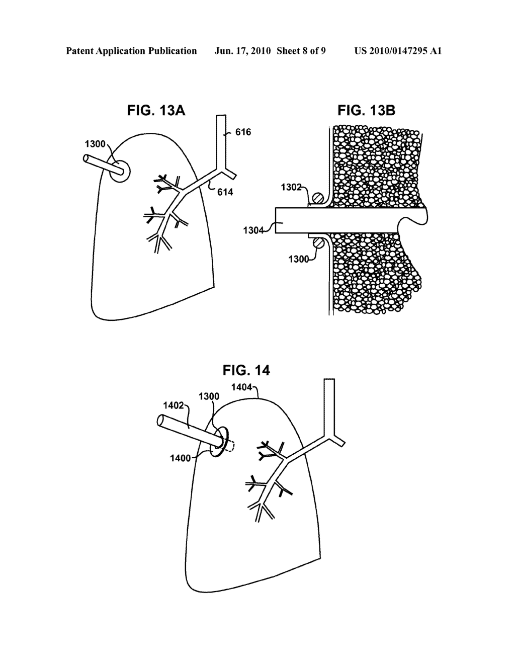 DEVICES AND METHODS TO CREATE AND MAINTAIN THE PATENCY OF AN OPENING RELATIVE TO PARENCHYMAL TISSUE OF THE LUNG - diagram, schematic, and image 09