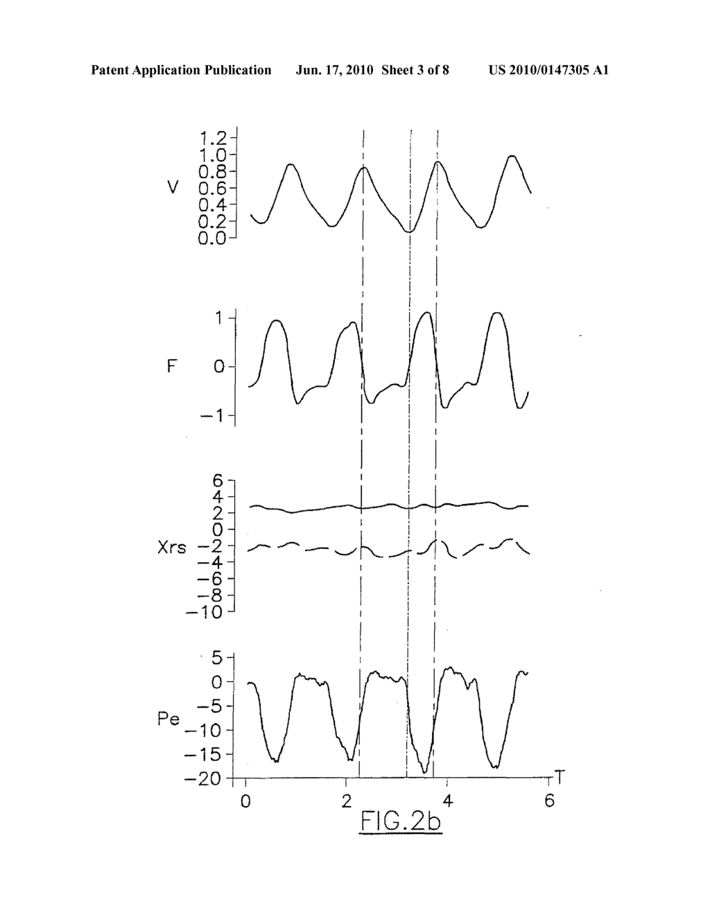 System and Method for the Automatic Detection of the Expiratory Flow Limitation - diagram, schematic, and image 04