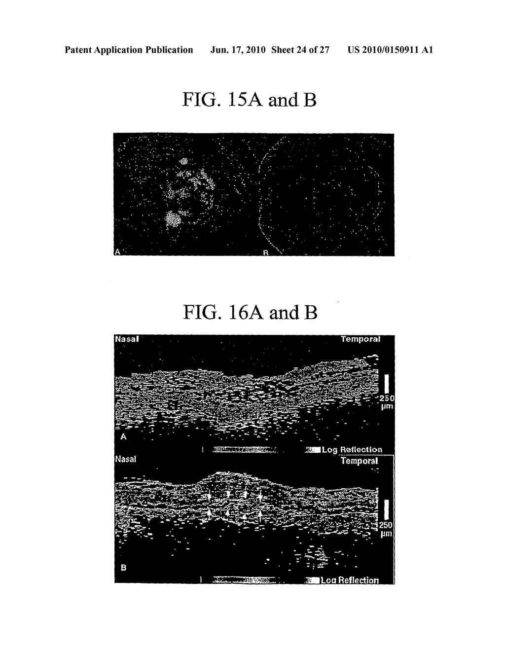 METHODS AND SYSTEMS OF TREATING AGE-RELATED MACULAR-DEGENERATION - diagram, schematic, and image 25