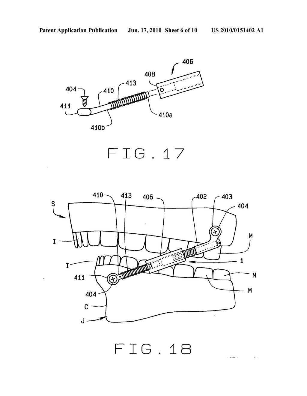 Slide on connector for arch wire - diagram, schematic, and image 07