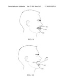 TEMPORARY RESTORATIONS AND RELATED METHODS diagram and image