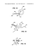 Gastric Band System with Esophageal Sensor diagram and image