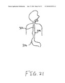 Gastric Band System with Esophageal Sensor diagram and image