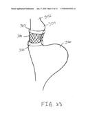 Gastric Band System with Esophageal Sensor diagram and image