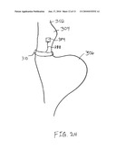 Gastric Band System with Esophageal Sensor diagram and image