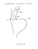 Gastric Band System with Esophageal Sensor diagram and image