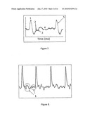 NON-INVASIVE DEVICE NADI TARANGINI USEFUL FOR QUANTITAVE DETECTION OF ARTERIAL NADI PULSE WAVEFORM diagram and image