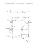 IMPLANTABLE TELEMETRIC DEVICE FOR HEART MONITORING diagram and image