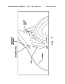 ULTRASONIC TREATMENT OF GLAUCOMA diagram and image