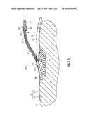 WOUND TREATMENT APPARATUS diagram and image