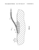 WOUND TREATMENT APPARATUS diagram and image