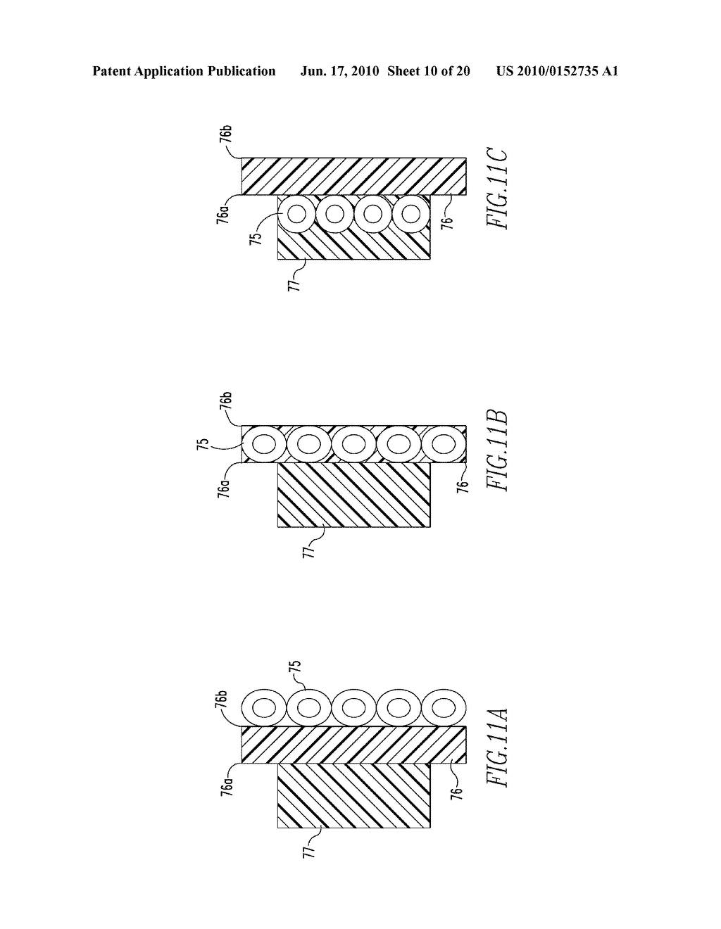 SYSTEMS AND METHODS FOR INSTALLING AND REMOVING AN EXPANDABLE POLYMER - diagram, schematic, and image 11