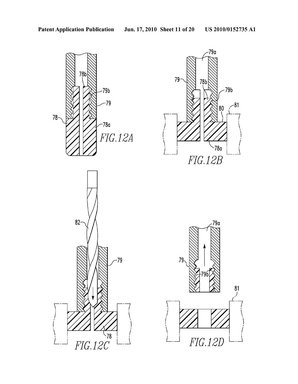 SYSTEMS AND METHODS FOR INSTALLING AND REMOVING AN EXPANDABLE POLYMER - diagram, schematic, and image 12
